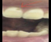 What is the severity of this cavity? And would it be considered an enamel cavity or a dentin cavity? What is the difference? Im interested in studying dentistry and would like to know from karol cavity