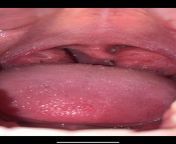 Are my tonsils huge? Ive been told ever since a babg my that I have abnormally large tonsils . Dentists and doctors are always shocked! Are they? from tonsils