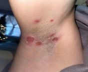 Appeared yesterday in right armpit. No fever but is painful. Looks like lesions/blisters from naturists fkk pictures international magazine no 28 jpg jung und frei nude nudist family sonnenfreunde sonderheft maga