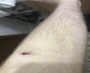 (Apologies for hairy leg) climbing incident when partner stepped on rock sending it straight to my shin. Entire shin bruised :/ from shin koihime † musou kakumei