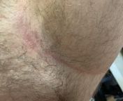 Rash in groin, butt, and armpits. Ive had this rash going on for about 3-4 years. I first noticed it in my armpits after using deodorant that was left in my car and melted and then re-hardened. from indian aunty massage penis in massage parlourhabhi and devar sex india hindi sex adio