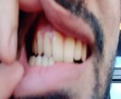 my dentist told me I had recession in one tooth and to get an electric toothbrush. after using it I think the root is exposed in many of my teeth now. What should I do? Should I consider a gum graft? from exposed in tiktok
