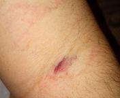 Recently had to give blood for a lipids test. The person who attended me was clearly a student and now I have this on my arm. I just would like to know is this a blood clot or internal bleeding in any way? from loos blood virgin