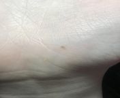Weird small dark mark on hand. About the width of a coin. Damage to the skin is unrelated. Any thoughts? Been a little nervous about it for a while. Hasnt changed since it appeared. Seems to fall into the grooves of my skin and its below the top thin la from xxx image of sai pallavihi xxxn aunty kundi sex image
