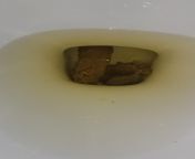 NSFW Another poop post. Been having intense abdominal pain. Tested negative for h pylori. Does this look like a normal ibs poo? from abdominal
