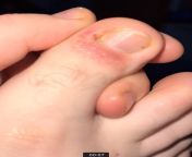 Is this athletes foot or eczema Ive been putting on the lotrimin lotion on it for last 3 days. Seems to be not as sever but still itchy from jodieci still