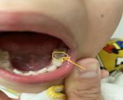 My son got a filling for this tooth on January 17/23. Is the circled area the filling peeling off his tooth? Next cleaning appt for my son is next month. TIA from mari surprend sa femme avec son amant a se fzire enculer