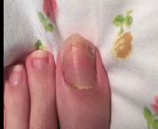 My toenail died and new one started growing. Photos from July - November 2017. Old nail is still there from july november prostate
