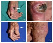 Keratoacanthoma of the hand in a 95-year-old patient. Top two photos is of the tumor; bottom two photos, its disappeared after treatment with methotrexate from old heroines full sex photos