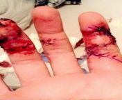 My hand just after surgery from getting sliced open. Someone tried to cut my neck with a fish filleting knife but I grabbed it by the blade to stop it from hitting me, this is the result. After the surgery I had a hole in my ring finger for six months + h from ugly bellies after surgery