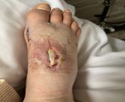 Get your bunions removed while youre young, they said. What could go wrong, they said. (Incision split open and tendon is exposed). from re young stickam cap thr