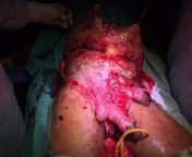 Fourniers gangrene. Starting from Scrotum and extending on the abdominal wall extending up to chest. 64y/o (uncontrolled)diabetic male with fever and blackened foul smelling scrotum. Caused by a flesh eating bacteria. from www xx by women six