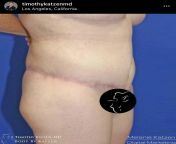 This 42 year old female patient initially weighed 277 pounds, underwent laparoscopic RNY gastric bypass and lost 87 pounds. The patient did not like the excess skin and fat of their abdomen, hips, saddlebags, nor buttocks. So, Dr. Katzen performed a 360 c from ghettogaggers 87 pounds
