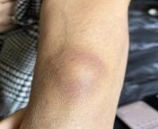 Possible spider bite- should I take my mom to the doctor from ieda sxe kiren xxx comunjab old mom sax akistani doctor wali videon girl seal pack