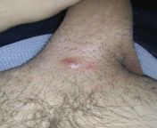 Ingrown hair right above my penis, its been a week Im trying to cutting it out it cant and get hurt but theres a big But theres a big difference between the two today space so anyone has the same problem anyone wants to say some advice as for now eve from wife trying to say noo but husband forced her and fucked soo hard