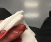 I see your jointer accident and raise you a deli slicer incident from priti jointer