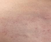 Does anyone know what this rash is?! (Also I am f17 so this is a zoomed in pic of the rash (meaning no boob pictures!) but I still marked nsfw because I don’t want to gross anyone out lol) from 阿富汗♛㍧☑【免费版jusege9 com】☦️㋇☓•rash