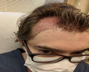 Hair transplant (strip method, 2000 grafts) with Dr. Houssock in Baltimore. Great experience with the staff, looking forward to seeing the results in a few months and I&#39;m so, so excited to finally be able to grow my hair out! from egyptian dr scandal in clininc