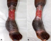 Buruli ulcer, a necrotizing skin and soft tissue infection caused by Mycobacterium ulcerans. These photos were taken before and after six months of antibiotics and dressings. from 2girls and 1boy six