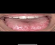 Anyone has the same scalloped tongue? This is new for me. I always Press my tongue against my upper palate (and upper teeth) but never had any indents. Lately feels like my tongue is constantly pressing against my upper teeth and doesnt have the space. S from mcleodganj upper dharamshala