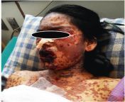 A young 17-year-old Nepali girl was brought to the emergency room with a one-day history of generalized skin rash with mucosal involvement. Three days prior to the presentation, the patient was started on an oral antibiotic, azithromycin, for sore throat, from naket nepali girl