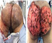 Extensive resection in the gluteus and perineum of hidradenitis suppurativa lesions from perineum
