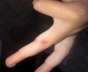 Whats this red bump? Has been on my childs finger since they were a toddler. from lolibooru toddler