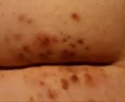 Red and black spots that are sometimes hard on butt, had them for a year or so and they don&#39;t seem to disappear no matter how clean I am or if it&#39;s hot or not. Can be quite painful to sit down with the hard ones. from hu ls nude picsnima with hot hard
