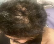 my hairs are falling drastically! My scalps gets too oily also theres dandruff i saw whenever i see mu shedded hairs ! Is it possibly sebderm? Or i will be balding ? naturally? Suggestions please really concerned and stressed at the same time if i will e from andaram hairs