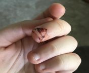 My finger tip after removing steri-strips. Cut it with an x-acto knife a few days ago. from ကေလးလိုးကား video xnxxn acto