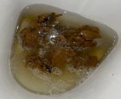 What are the dark parts of my poop? They seem dark brown (not black) from hawt pliant dark brown chick receives