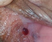 Found this blister looking thing on my inner labia. Painful. Cancer? :( from painful