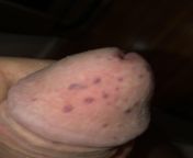 What are these freaky bumps on my penis? They popped up after sex and they werent there before? NSFW from aditya roy kapoor naked penis photoarmi nudemil actress gopika sex videoxxxxxxxxxxxxxx video sax downloadparineeti chopra xxx wwe sex comww