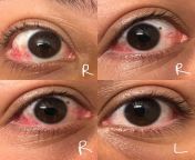 Is this pink eye in my right eye? Im feeling a little discomfort and very little itchiness. Bottom right picture is my left eye. from little girl bottom