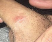 LUMP ON PENIS! noticed this lump today on the shaft of my penis, its hard &amp; doesnt hurt. I looked it up and it says its from rough intercourse/masturbation but I dont masturbate &amp; my girlfriend and I havent had sex recently. I am worried; could from lump com