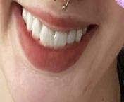 3 and a half weeks out after dental implants, I have a temporary fixed bridge.All sutures are removed and closed. not smoker. So when can I have oral sex with a man &amp; woman? if they (man and woman) have a pricing should I avoid it and if so how long? from and woman fu