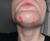 Troubles with LHR on chin &amp; lip. 8th treatment, still no results (was even told so by the tech yesterday). Going every 4 weeks, spending 2 weeks taking care of my chin swollen, blistered, and in pain after sessions. Im obviously fair skinned, with bl from 2 sister taking care of sick father