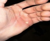 Hey I have a question about my hand. I have this corn thing in in my hand and I tried removing it but my hand got swollen. I did a hand bath with soda. Do you guys have any tips? It hurts bad btw from hand lose6262（mini777 io）6060 philippines online entertainment rescue unhappiness hand lose6262（mini777 io）6060 philippines gambling prize naghihintay sa iyong hamon hand lost6262（mini777 io）60 60 philippines gaming full time na reverse profit vdf