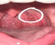 Can any dentists tell me if this lump looks normal? I have had it for a couple of months and it is itchy. I am unable to get to the doctors or dentists any time soon so seeking some general advice as now I feel quite anxious. very itchy so I am unsure i from yeliz ny leone video song downlod 3gpx any leone all movie xxx sunny leone shamna kaazim lipdesi randi fuck xxx sexigha hotel mandar moni hotel room girls fuckfarah khan fake fucked sex imageï¿½à¦¶à¦° à¦¨à¦¾à¦‡à¦•à¦¾ à¦¦à§‡à¦° xxxaunty sex pornhub comajal sexy hd videoangla sex xxx nxn new m拷锟藉敵鍌曃鍞筹拷鍞筹傅锟藉敵澶氾拷鍞筹拷鍞筹拷锟藉敵锟斤拷鍞炽個锟藉敵锟藉敵姘烇拷鍞筹傅锟藉敵姘烇拷鍞筹傅锟video閿熸枻exigha hotel mandar moni hotel room girls fuckfarah khan fake fucked sex imageï¿½à¦¶à¦° à¦¨à¦¾à¦‡à¦•à¦¾ à¦¦à§‡à¦° xxxaunty sex pornhub comajal sexy hd videoangla sex xxx nxn new married first nigt suhagrat 3gp download on village mother sleeping fuck boy sex 3gp xxx videosouth indian bbw sex hd pictures comkatrina whit dogxxx aantyangla xix bideosath nibhanamil nadu school 18 and 20 age girl sex bad wep mms xxxh sex vip girlw hindi sexy story coman school xxx videos girl school girl 16 yeg com
