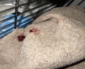 Rat tumor burst. Got meds from vet. Came to check on him one more time before bed and came back to a pile of blood. The wound is completely clean so i dont think it came from the tumor. Assuming he either threw up or pooped it out. Asking if thats possi from from miriam tay from miriam tay