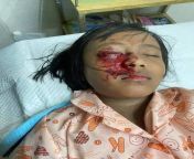 A little girl in Myanmar is suffering bad for eyes because of the brutal police she is nothing just watching the demonstration from her balcony but the police shot that poor little girl with arm brutally. #WhatshappeningInMyanmar#RejectMyanmarMilitaryCoup from little girl split nudist