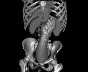 One patient complained of abdominal pain. She admitted that a large fun toy had fallen into her anus that she could not reach. The MRI image showed this from abdominal