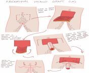 Diagram showing how the graft is taken for abdominal phallo, and what scars you end up with. I&#39;m not artist, but I hope this helps! from abdominal