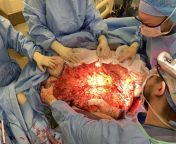 Necrotizing fasciitis in a 500 lb patient, removed skin from left side of abdomen up to breast and down to vagina. from breast and vagina sucking