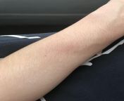 Does this look like the start of a HIV rash? from japan hiv se