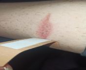 Is this burn infected ? It&#39;s been healing for 5 days now, 3 days after the blister popped by itself from xxx video colossal old nani blister fuck by small brother kamwali bai sex 3
