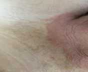 I have had this Rash/Jock Itch for quite a while around my crotch area. Ive been putting Gold Bond powder and Blue Star cream on it. Nothing has worked and it is causing a lot of pain. Can anyone help?? from sunny leon vivid blue star porn bideo 2