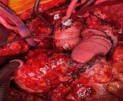 My heart during a surgery! from hidrosel surgery