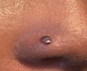 Help Ive gotten my nose pierced in July and since I got it, Ive got the bump 3x. And I heard that if you put the Chamomile tea on the bump, so I did it and..it turned dark. Mind you before that it pop with pus so what do I do? from devierge pus
