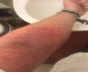 Had my first outbreak ever this year in January pretty much all over my body after it developed in about 2 weeks and starting to itch like crazy. Now 4 months later Im clear of all skin irritation and feel way better after being treated with 35 PUVA bath from puva xxximai sxe